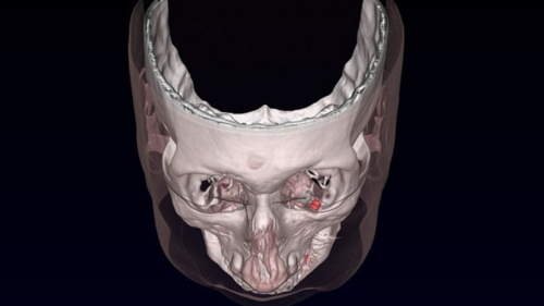 implantes para os olhos